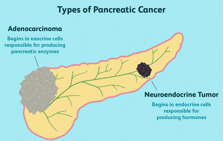 pancrea