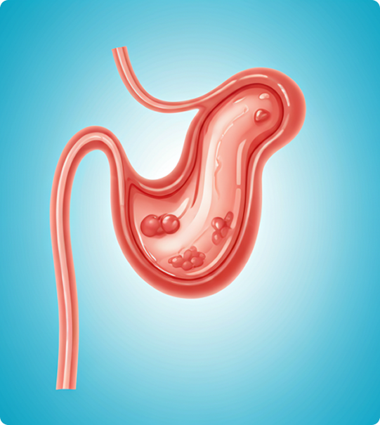 Sleeve Gastrectomy