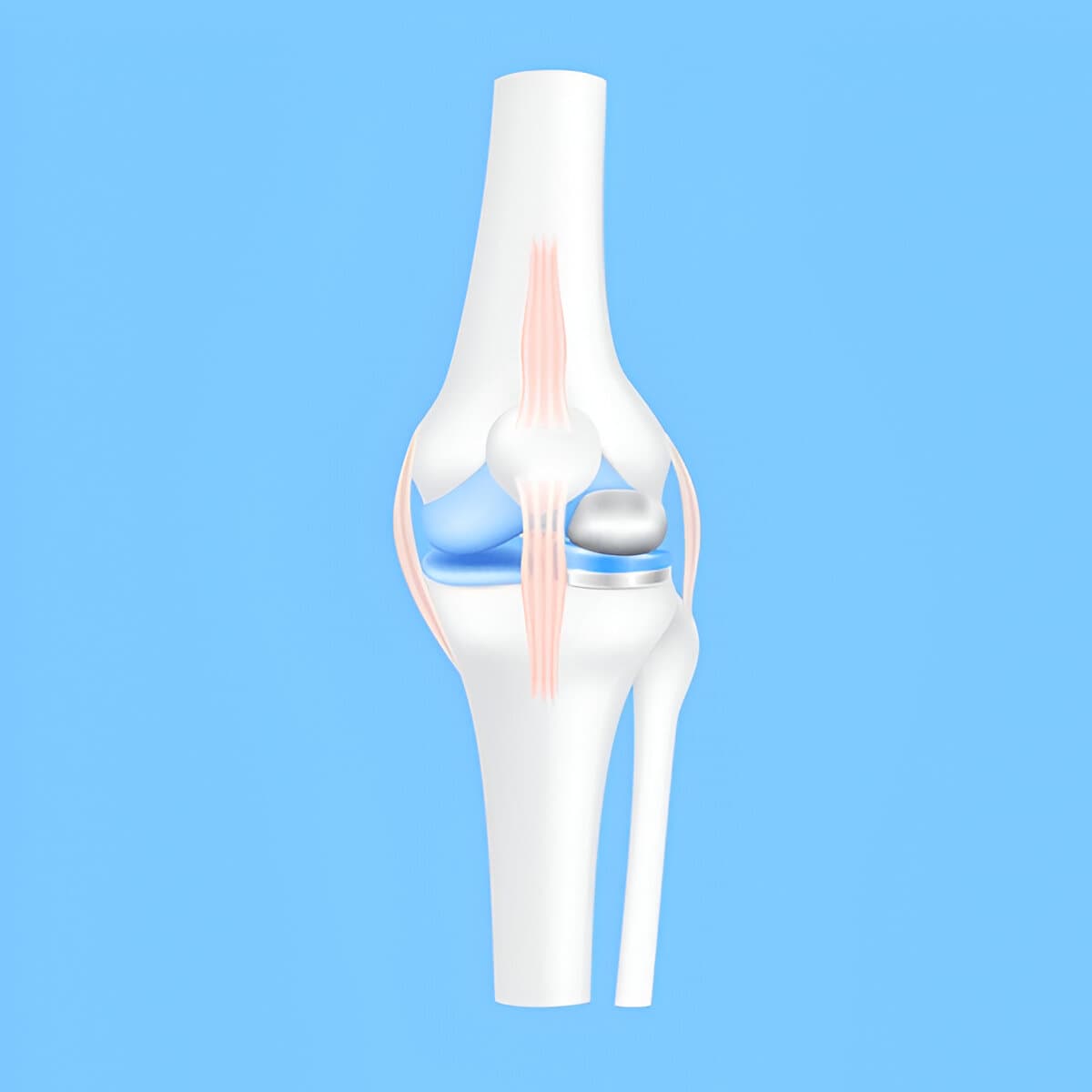 Knee Osteotomy