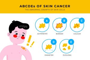 skin cancer ABCDE
