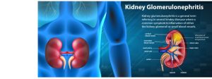 Glomerulonephritis