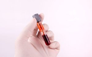 serum creatinine blood test
