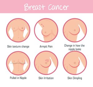 Breast cancer symptoms