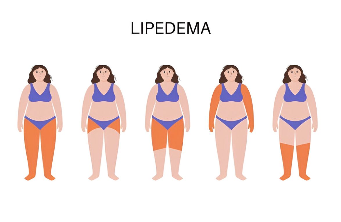 What Is Lipedema Understanding the Fat That Won’t Go Away - Omega Hospitals
