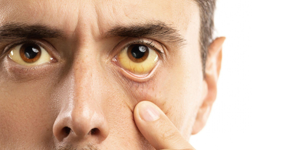 Jaundice (yellowing of the skin and eyes)