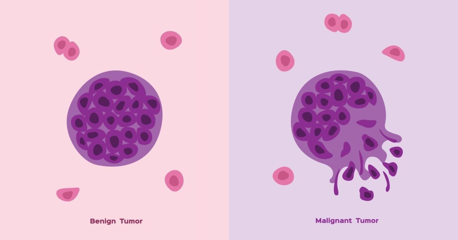 Benign Tumors Explained: Key Facts and Insights You Should Know