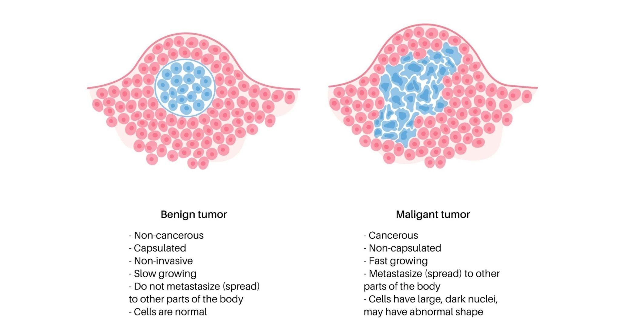 Benign Tumors Explained: Key Facts and Insights You Should Know