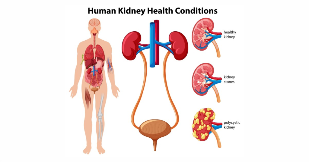 Foods That Cause Kidney Stones – What To Avoid And How To Stay Healthy Omega Hospitals1