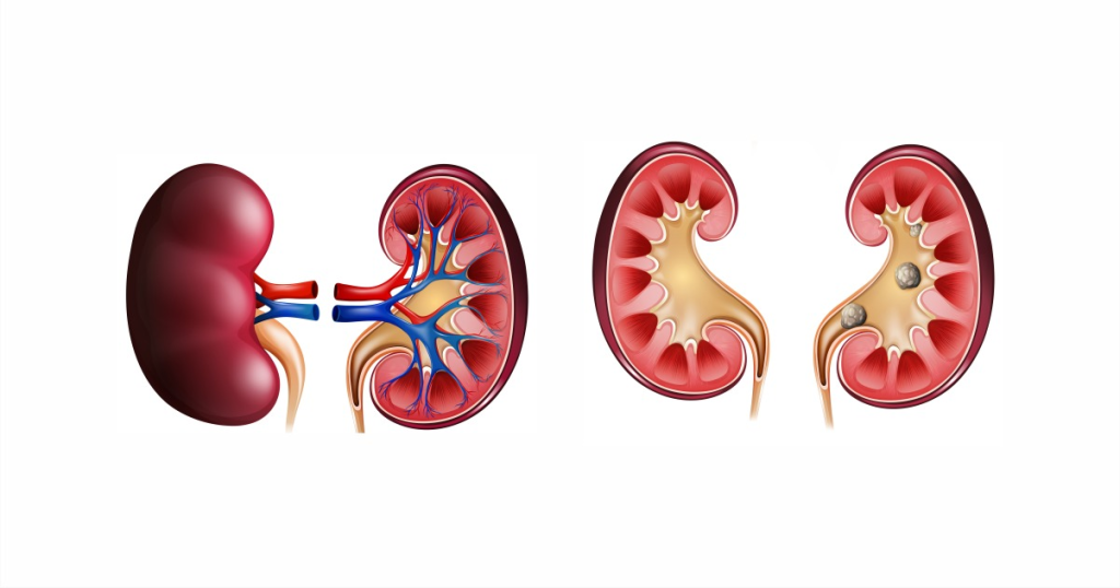 Foods That Cause Kidney Stones – What To Avoid And How To Stay Healthy Omega Hospitals2