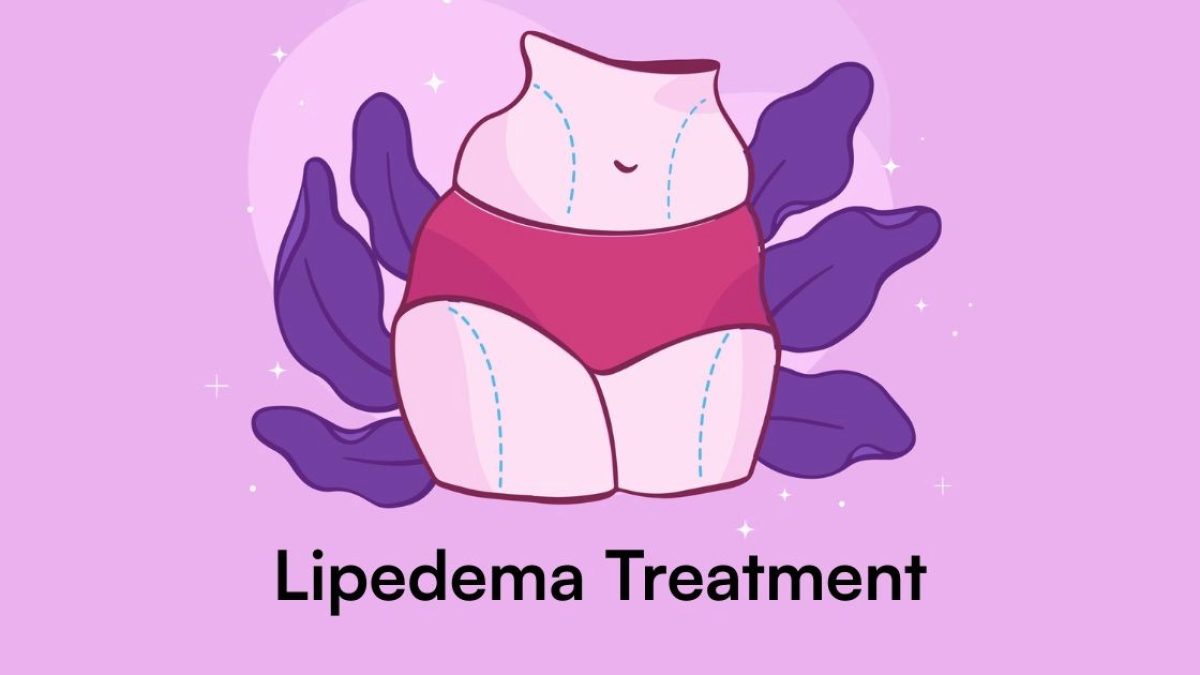 Lipedema Treatment Options: Surgery, Compression & Beyond