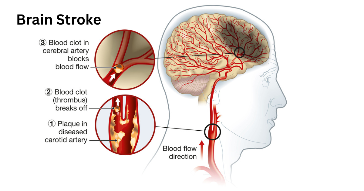 “He Remembers… Sometimes”: The Silent Reality of Blood Clots in the Brain