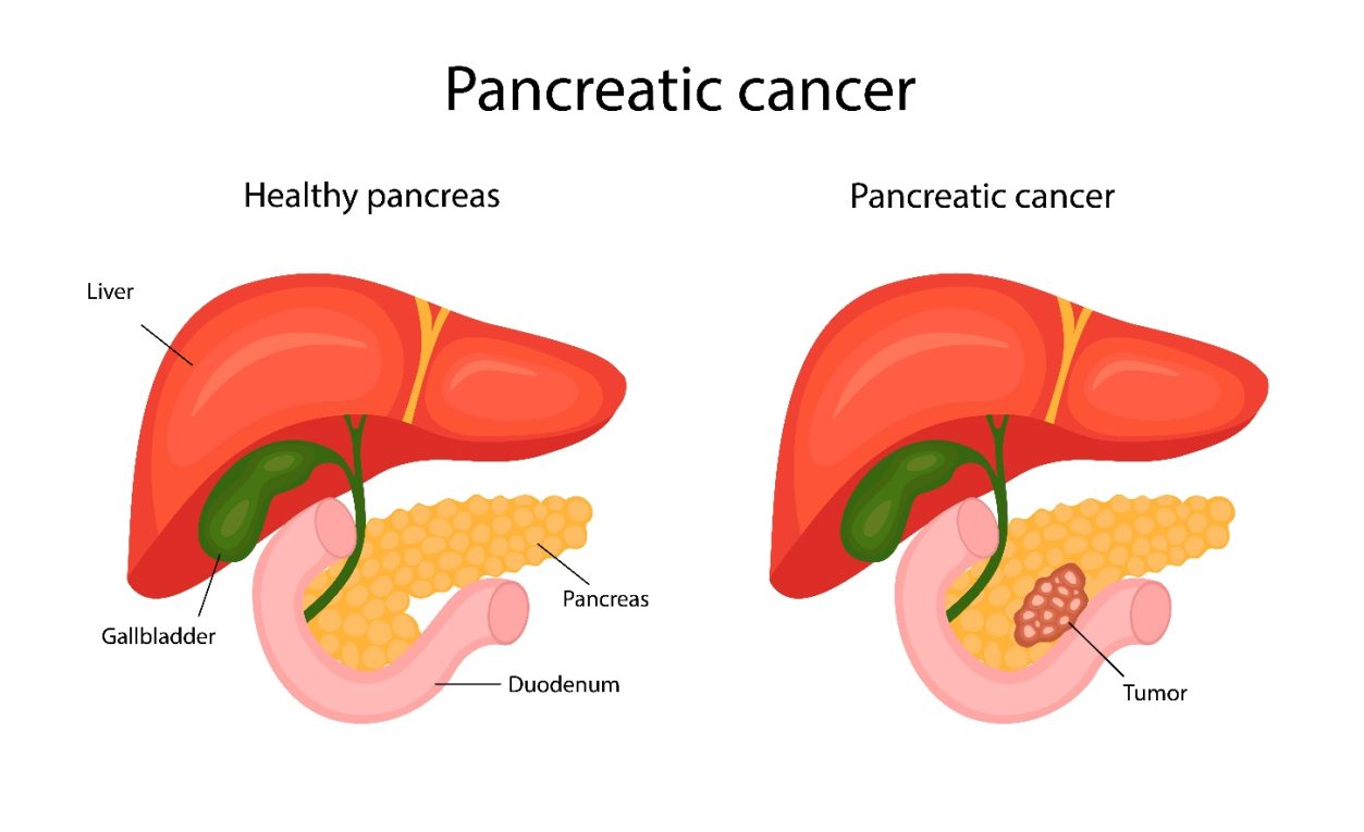 Pancreatic cancer – Types, Symptoms, Causes, Risk Factors, Tests, Treatment